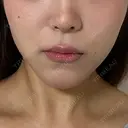 ピーリング（ニキビ・毛穴） ヴァージンクリニック 福岡天神院 AFTER サムネイル用