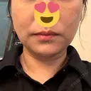 糸リフト / 脂肪吸引注射（顔） 新宿美容外科ネビュラクリニック DAY 16 サムネイル用