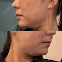 糸リフト / 脂肪吸引注射（顔） 新宿美容外科ネビュラクリニック DAY 16 サムネイル用