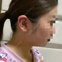 糸リフト / 脂肪吸引（顔） / ジョールファット除去 GRACIA clinic 【グラシアクリニック】 DAY 4 サムネイル用