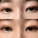 二重切開 表参道スキンクリニック 表参道院 DAY 100 サムネイル用