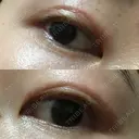 二重切開 表参道スキンクリニック 表参道院 DAY 100 サムネイル用