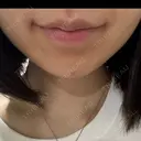 ボトックス（あご） / ボトックス（口角） DMTC CLINIC 渋谷院 DAY 1 サムネイル用