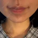 ボトックス（あご） / ボトックス（口角） DMTC CLINIC 渋谷院 DAY 4 サムネイル用