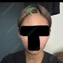 ボトックス（エラ・小顔） 札幌TAクリニック DAY 8 サムネイル用