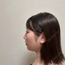 糸リフト / バッカルファット除去 / 脂肪吸引（顔） / メーラーファット除去 / ジョールファット除去 / ボトックス（あご） First Clinic DAY 14 サムネイル用