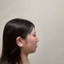 糸リフト / バッカルファット除去 / 脂肪吸引（顔） / メーラーファット除去 / ジョールファット除去 / ボトックス（あご） First Clinic DAY 14 サムネイル用