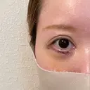 下まぶたたるみ取り / その他（目元） ネビュラクリニック 京都院 DAY 3 サムネイル用