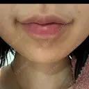 ボトックス（あご） / ボトックス（口角） DMTC CLINIC 渋谷院 AFTER サムネイル用