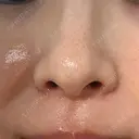 エレクトロポレーション / レーザートーニング（美白・かんぱん） トラスト美容クリニック 銀座院 DAY 3 サムネイル用