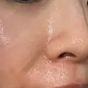 エレクトロポレーション / レーザートーニング（美白・かんぱん） トラスト美容クリニック 銀座院 DAY 3 サムネイル用