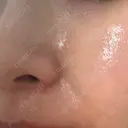 エレクトロポレーション / レーザートーニング（美白・かんぱん） トラスト美容クリニック 銀座院 DAY 3 サムネイル用