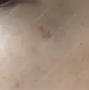 ルメッカ Clinic K Blossom DAY 5 サムネイル用