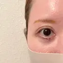 下まぶたたるみ取り / その他（目元） ネビュラクリニック 京都院 DAY 4 サムネイル用