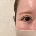 下まぶたたるみ取り / その他（目元） ネビュラクリニック 京都院 DAY 4 サムネイル用