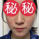 ピコレーザートーニング（美白・肝斑） / ピコフラクショナルレーザー（毛穴・ニキビ跡） / ピコスポット 東京シルククリニック 東京神田院 AFTER サムネイル用