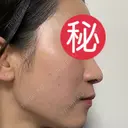 ピコレーザートーニング（美白・肝斑） / ピコフラクショナルレーザー（毛穴・ニキビ跡） / ピコスポット 東京シルククリニック 東京神田院 DAY 7 サムネイル用