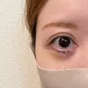 下まぶたたるみ取り / その他（目元） ネビュラクリニック 京都院 DAY 5 サムネイル用