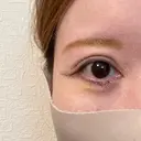 下まぶたたるみ取り / その他（目元） ネビュラクリニック 京都院 DAY 5 サムネイル用