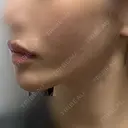 糸リフト / バッカルファット除去 / 脂肪吸引（顔） / ジョールファット除去 BLINC CLINIC （ブリンク クリニック） AFTER サムネイル用