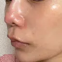 ヒアルロン酸注入（鼻翼基部） KIMI CLINIC 形成・美容外科 DAY 1 サムネイル用