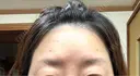ボトックス（エラ・小顔） / マイクロボトックス / ボトックス（眉間） 札幌美容外科ネビュラクリニック DAY 32 サムネイル用