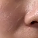 エレクトロポレーション / レーザートーニング（美白・かんぱん） トラスト美容クリニック 銀座院 DAY 8 サムネイル用