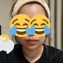 ボトックス（あご） / ボトックス（エラ・小顔） / 脂肪溶解注射（顔） / ボトックス（口角） / ボトックス（首） M'sクリニック【エムズクリニック】 DAY 5 サムネイル用