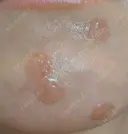 ほくろ・いぼ除去レーザー（肌） プライベートスキンクリニック 梅田本院 DAY 0 サムネイル用