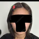 ボトックス（エラ・小顔） 札幌TAクリニック AFTER サムネイル用