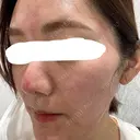 ピコレーザートーニング（美白・肝斑） / ピコフラクショナルレーザー（毛穴・ニキビ跡） 東京シルククリニック 新宿院 DAY 0 サムネイル用