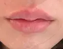 ヒアルロン酸注入（唇） 目白ホワイトクリニック DAY 0 サムネイル用