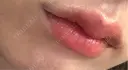 ヒアルロン酸注入（唇） 目白ホワイトクリニック DAY 0 サムネイル用