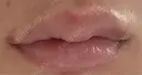 ヒアルロン酸注入（唇） 目白ホワイトクリニック DAY 1 サムネイル用