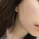 糸リフト / 脂肪吸引（顔） / 脂肪吸引（二の腕） / 脂肪吸引（脚） / 脂肪吸引（お腹） / 脂肪吸引（お尻） / 脂肪吸引（腰） / 脂肪吸引（背中） / 脂肪吸引（肩） ヴェルトラクリニック 新宿院 DAY 123 サムネイル用