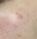 ルメッカ Clinic K Blossom DAY 8 サムネイル用