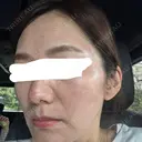 ピコレーザートーニング（美白・肝斑） / ピコフラクショナルレーザー（毛穴・ニキビ跡） 東京シルククリニック 新宿院 DAY 2 サムネイル用