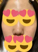 脂肪溶解注射（顔） ゆう美容クリニック DAY 0 サムネイル用