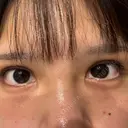 二重埋没 A CLINIC（エークリニック） 福岡院 AFTER サムネイル用