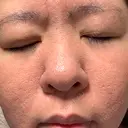 ニキビ治療 AB美容クリニック 新宿院 AFTER サムネイル用