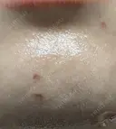 ほくろ・いぼ除去レーザー（肌） プライベートスキンクリニック 梅田本院 DAY 2 サムネイル用