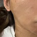 光治療（フォトフェイシャルなど） B-LINE CLINIC 大阪院 AFTER サムネイル用
