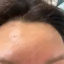 光治療（フォトフェイシャルなど） B-LINE CLINIC 大阪院 DAY 1 サムネイル用