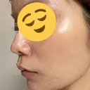 ヒアルロン酸注入（鼻翼基部） KIMI CLINIC 形成・美容外科 AFTER サムネイル用