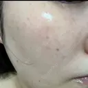 ルメッカ L‘amour clinic Tokyo【ラムールクリニック東京】 DAY 1 サムネイル用