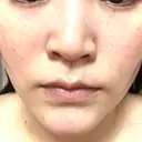 ルメッカ L‘amour clinic Tokyo【ラムールクリニック東京】 DAY 1 サムネイル用