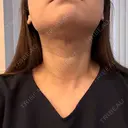 糸リフト / 脂肪吸引注射（顔） 新宿美容外科ネビュラクリニック DAY 22 サムネイル用