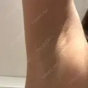 医療脱毛（ワキ） ルラ美容クリニック 新宿院 AFTER サムネイル用