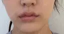 バッカルファット除去 ルラ美容クリニック 札幌本院 AFTER サムネイル用
