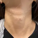 ヒアルロン酸注入（首） 美容皮膚科エルムクリニック 大阪院 DAY 0 サムネイル用